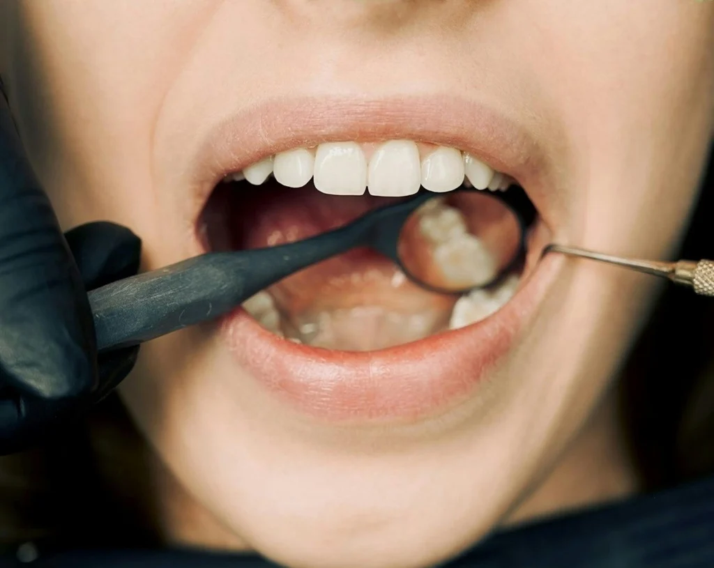 Dental Implant Care