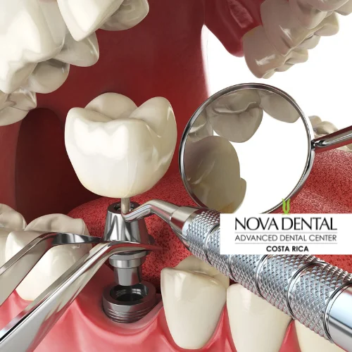 Implant Procedure: Discover the Step-by-Step Process of Dental Implant Placement
