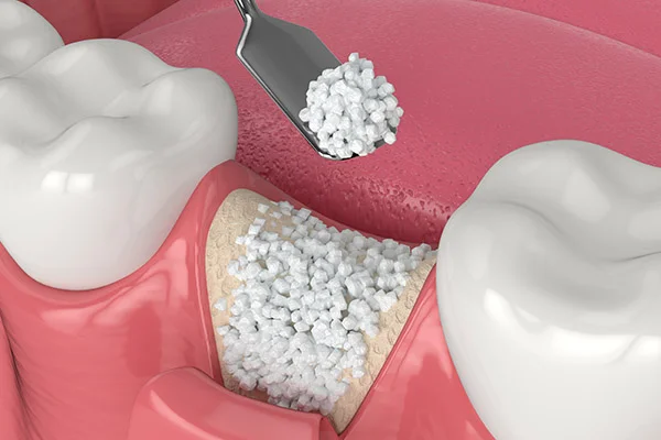 Bone graft procedure