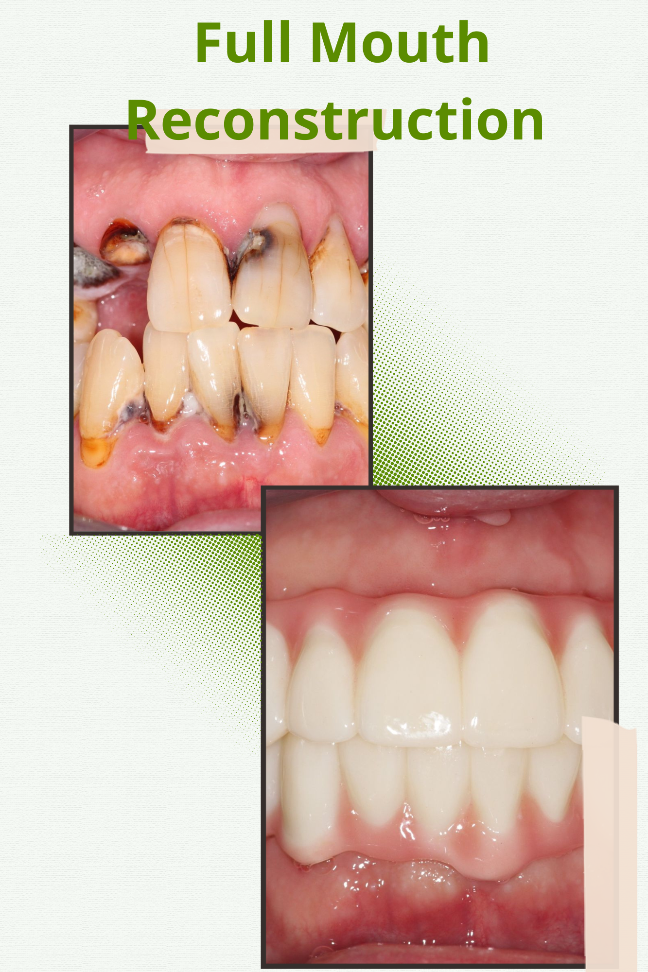 Full Mouth Reconstruction