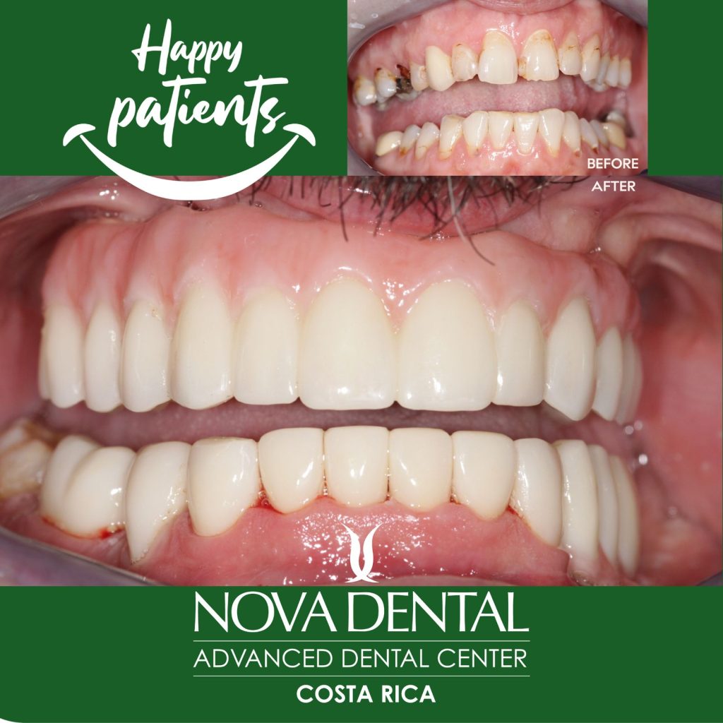 All on Four & All on Six Implants with Nobel Biocare, Straumann, and ZimVie – Transforming Smiles with Trusted Brands